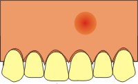 apicectomia dentale