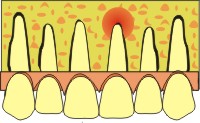apicectomia denti