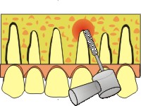 apicectomia dentista