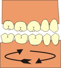 bruxismo dentale