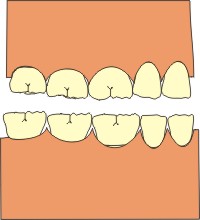 bruxismo dentisti