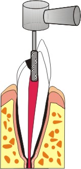 endodonzia denti