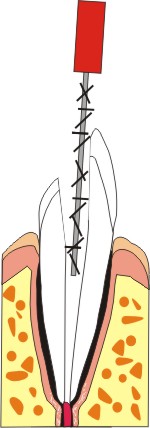 endodonzia dentista
