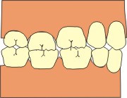 Malocclusione denti