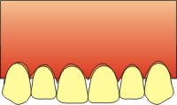 gengivite dentale