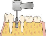 implantologia denti