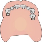 protesi combinata dentisti 