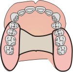 protesi combinata odontoiatrica