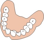 protesi mobile dentiera