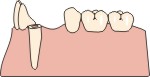 Perno moncone dentale