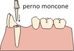 Perno moncone denti