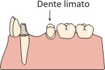 Perno moncone dentista