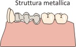 struttura per metallo ceramica dentisti bassano