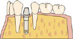 implantologia dentisti