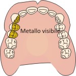 Lega-oro resina Dentisti Bassano