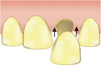 protesi fissa denti
