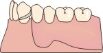 schaletrato con ganci odontotiatrico