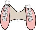 scheletrato con ganci odontoiatrico