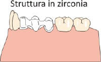 Zirconia Dentale