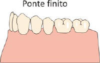 Ponte in Zirconia